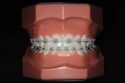 審美ブラケット(セラミックブラケット)