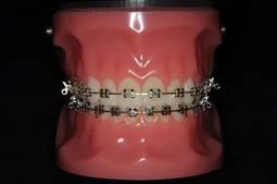 メタルブラケット